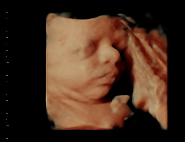 3D ultrasound image at 31 weeks